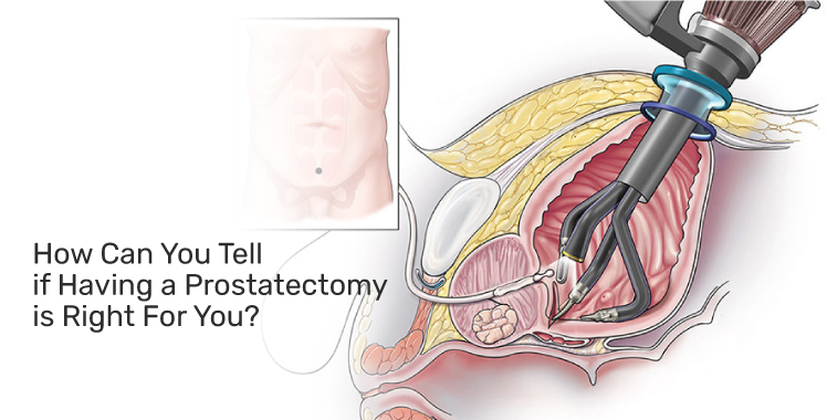 laparoscopic-prostectomy